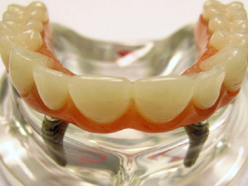 Diş implantları təhlükəli imiş - ALİMLƏRDƏN XƏBƏRDARLIQ