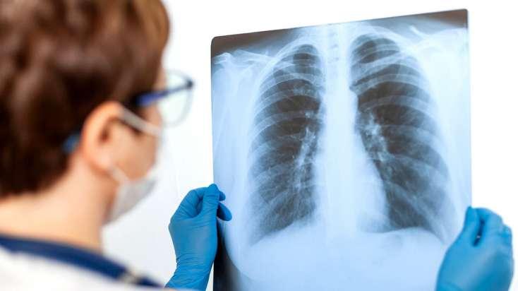 \"Bu şəxslərdə pnevmoniya riski yüksəkdir\" - Mütəxəssisdən XƏBƏRDARLIQ