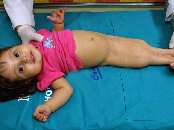 Dünyanın ən nadir sindromu - Adı qədər sevimli deyil