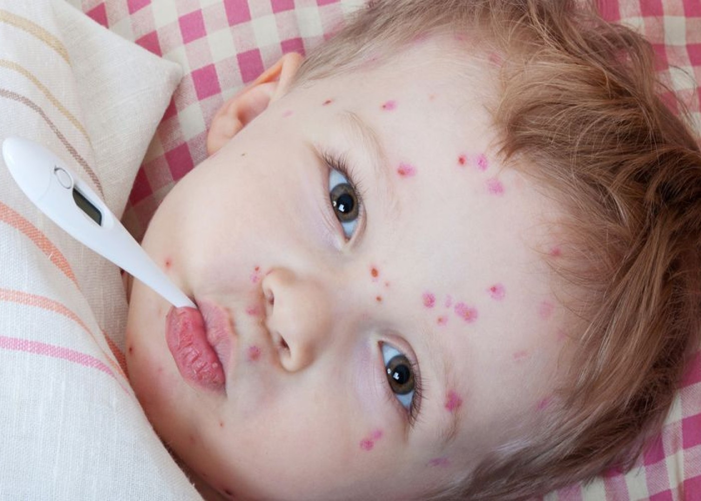 "Qızılcanın xüsusi müalicə üsulu yoxdur" - Həkim valideynin ən böyük səhvindən DANIŞDI