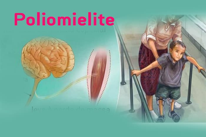Poliomielit xəstəliyi nədir və <span style="color:#ff0000"><b>ən çox kimlər yoluxur?</b></span>