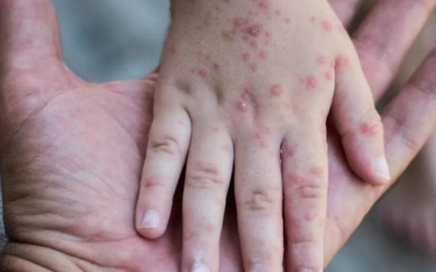 Monqolustanda qızılcaya yoluxanların sayı 7 mini ötdü