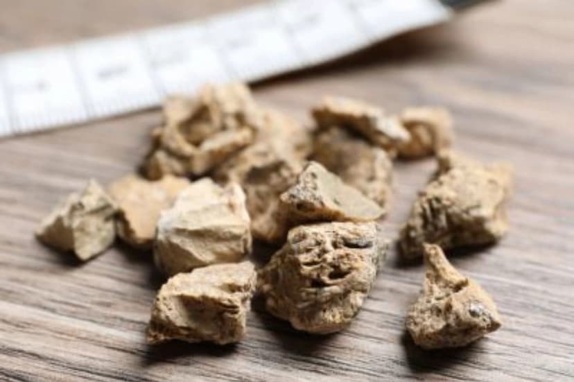 Alimlərdən böyrək daşlarına qarşı YENİ ÇARƏ