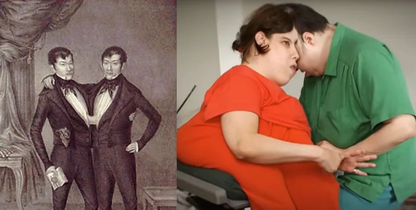 Bir ürək, iki insan: Tarixdə iz qoyan siam əkizləri