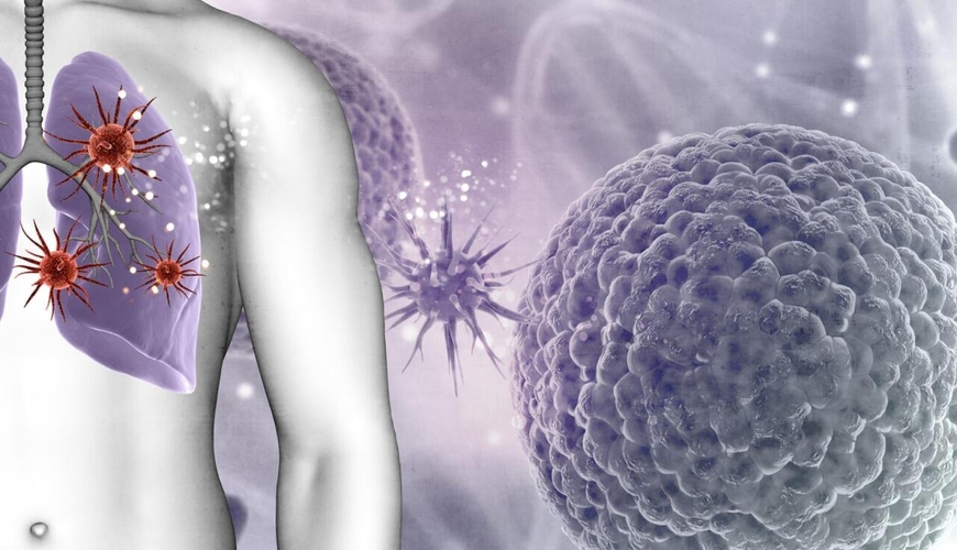 Alimlər ağciyər xərçənginin inkişaf səbəbini tapdı