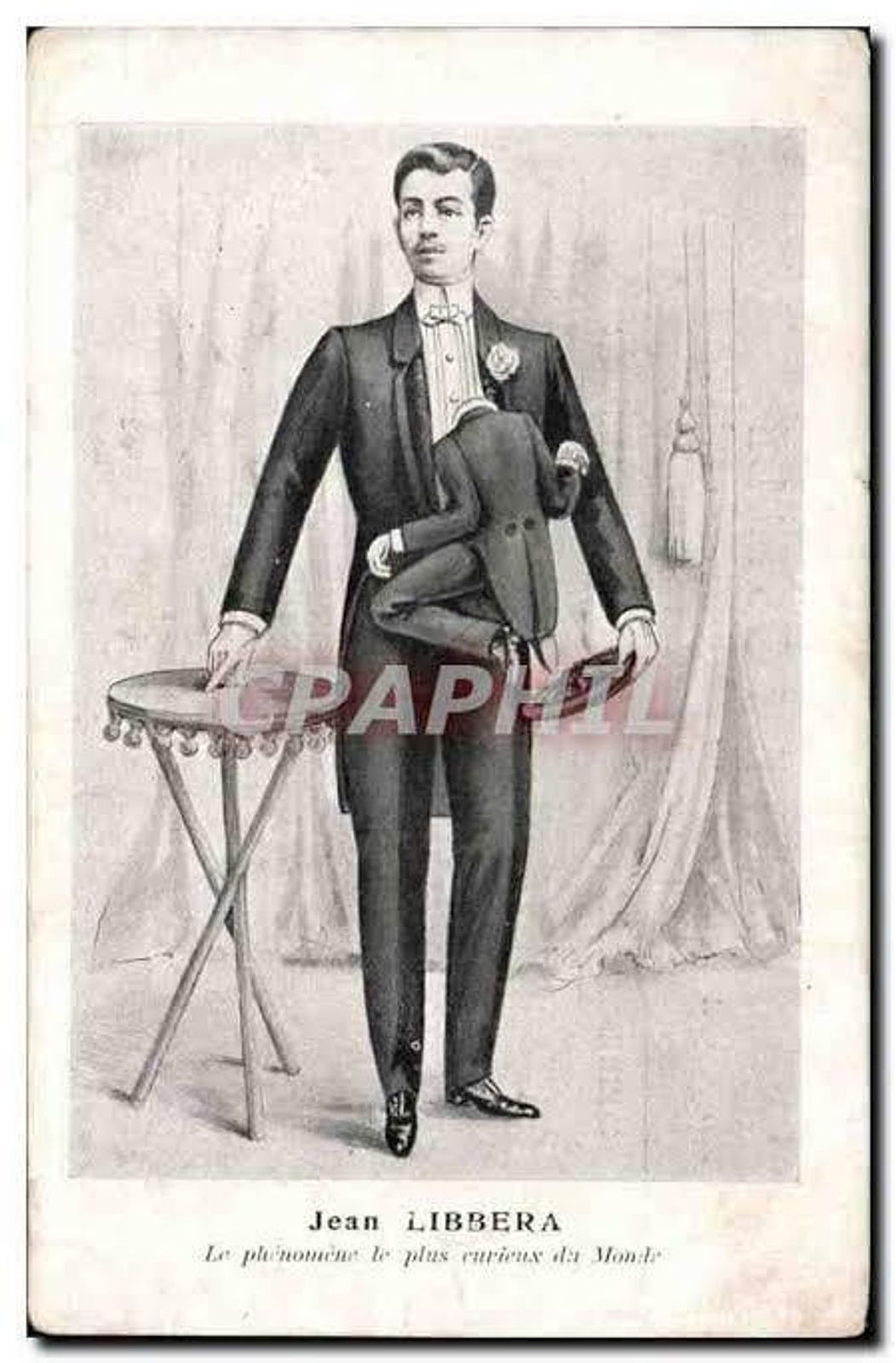 İllərlə eyni bədəni bölüşür: parazit əkizi ilə doğulan adam