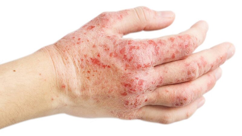 Bu vasitələr ekzema yarada bilər - Dermatoloqdan xəbərdarlıq