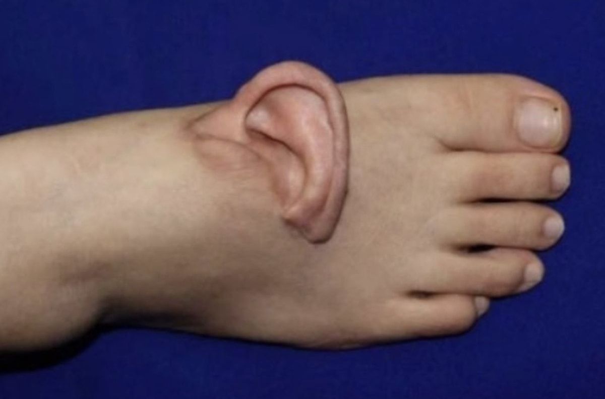 Kəsilmiş qulağını ayağına tikdilər: Çində tibbi möcüzə