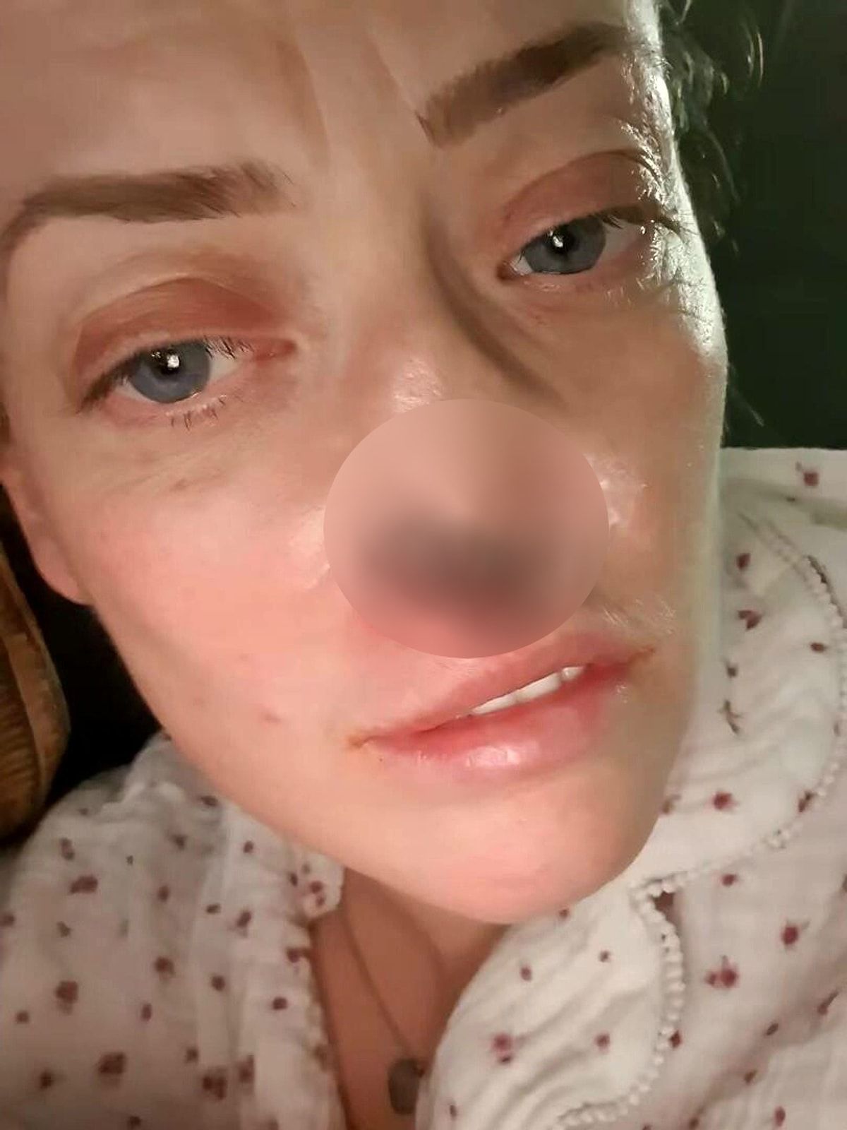 Diş implantı etdirdi: burnundan oldu