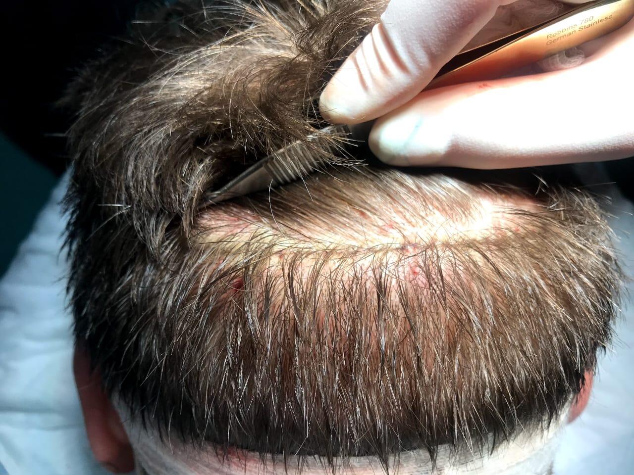 47 yaşlı kişi saç əkimi zamanı öldü