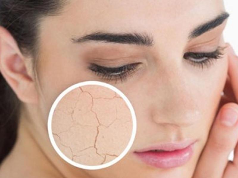 Soyuq hava dərinin düşmənidir: Özümüzü necə qoruyaq?