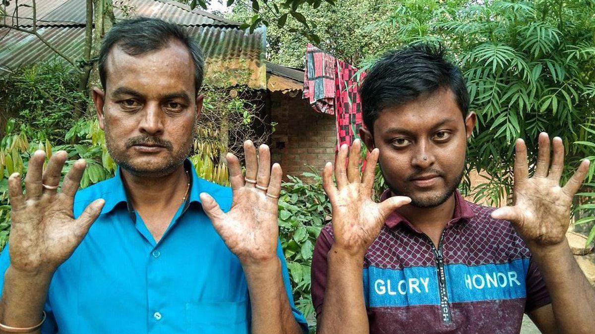 Barmaq izləri olmayan bu ailə nadir xəstəlikdən əziyyət çəkir