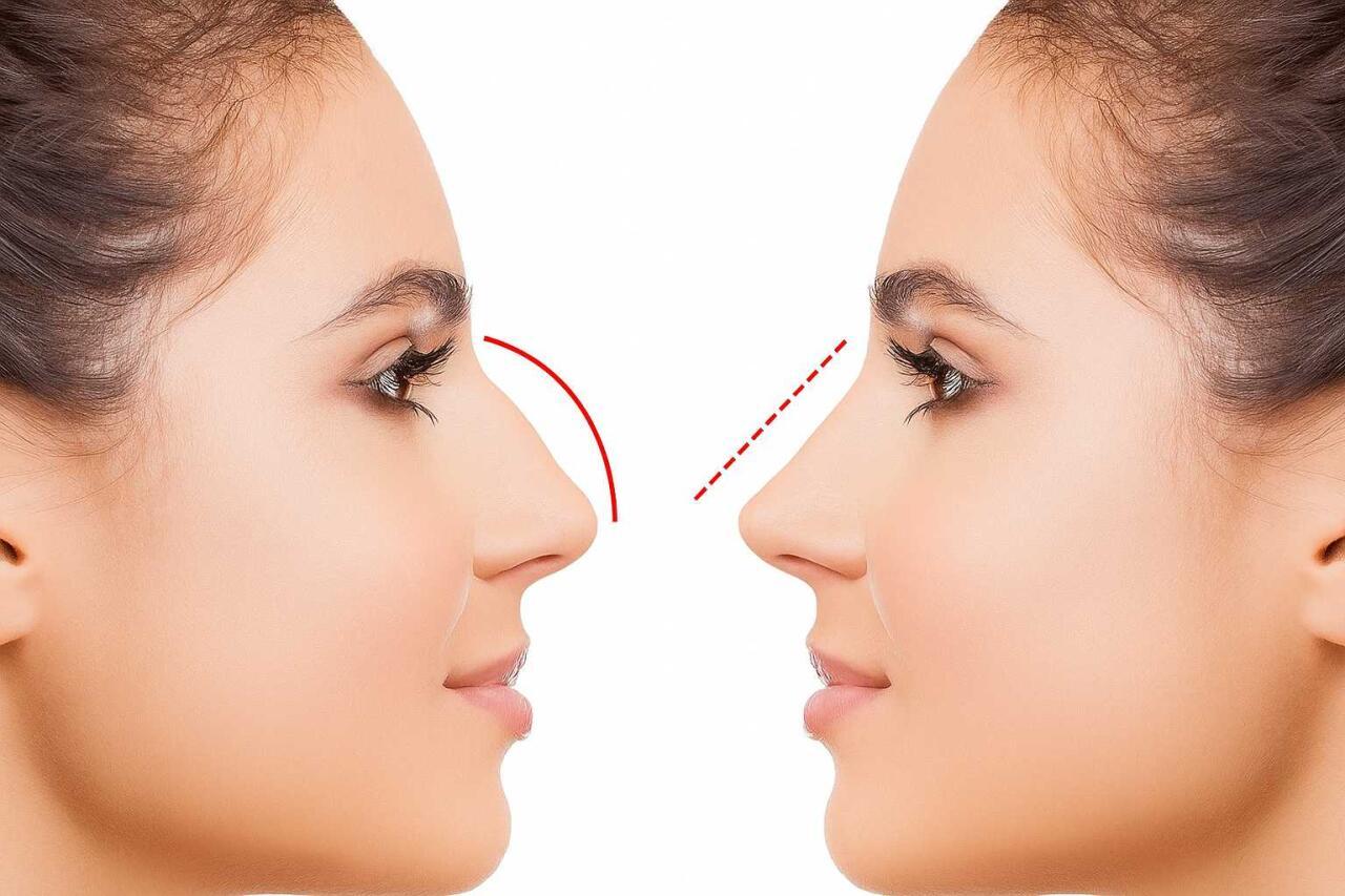 Azərbaycanda bu şəxslərə burun əməliyyatı pulsuz OLDU