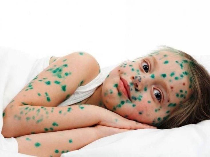 Su çiçəyi yenidən yayılır – Pediatrdan xəbərdarlıq