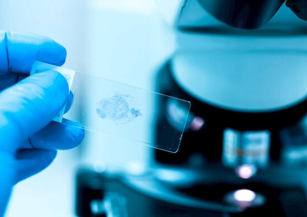 Ağciyər xərçəngi ilə bağlı qorxulu fakt