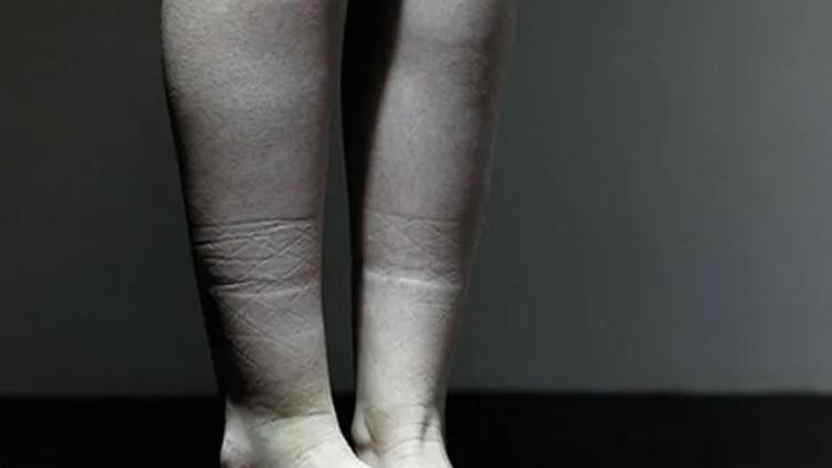 Ayaqlarda qalan izlərin səbəbləri