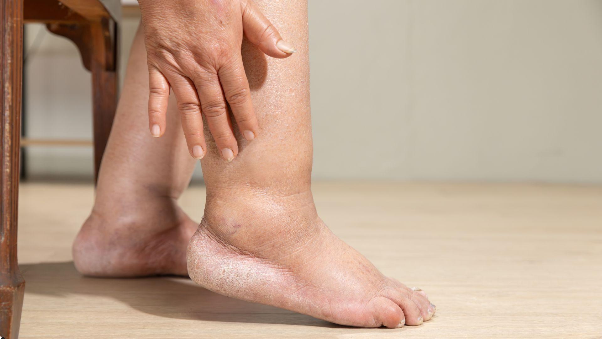 Ayaqlarda ağrı: Sadə yorğunluqdur, yoxsa damar problemi?