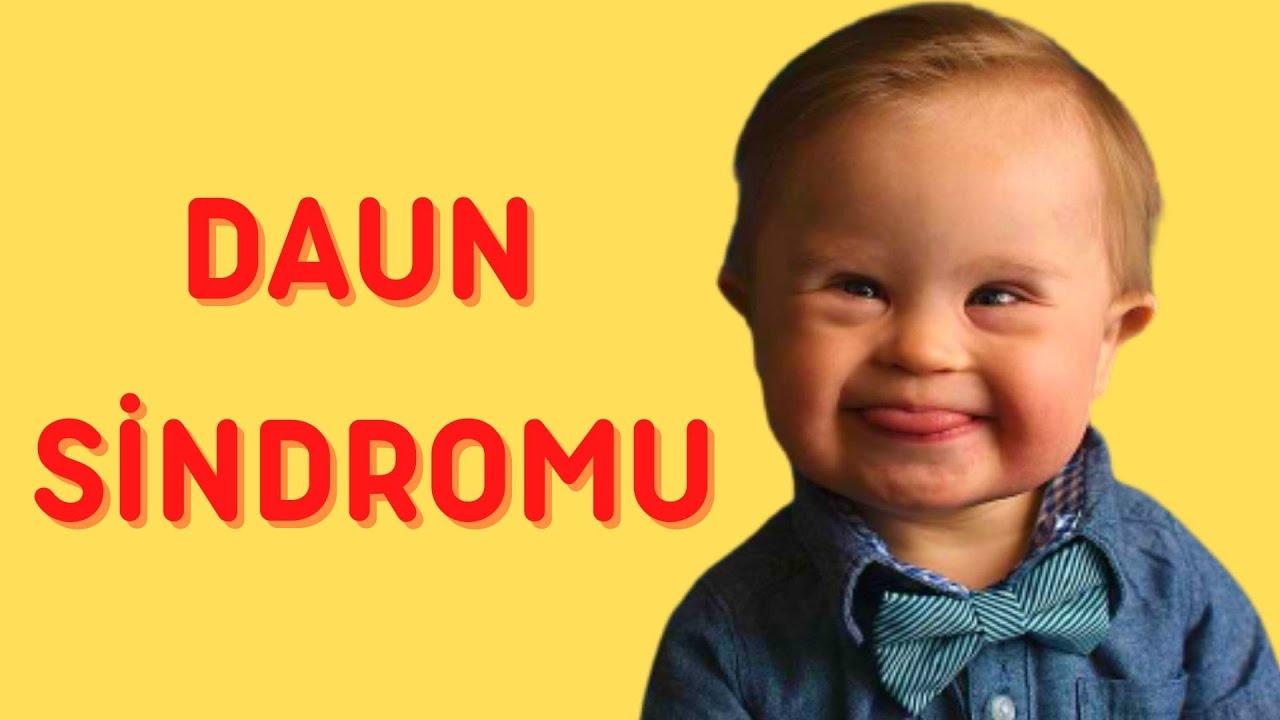 Dünya bu kəşfdən danışır: Daunun sonu gəlib