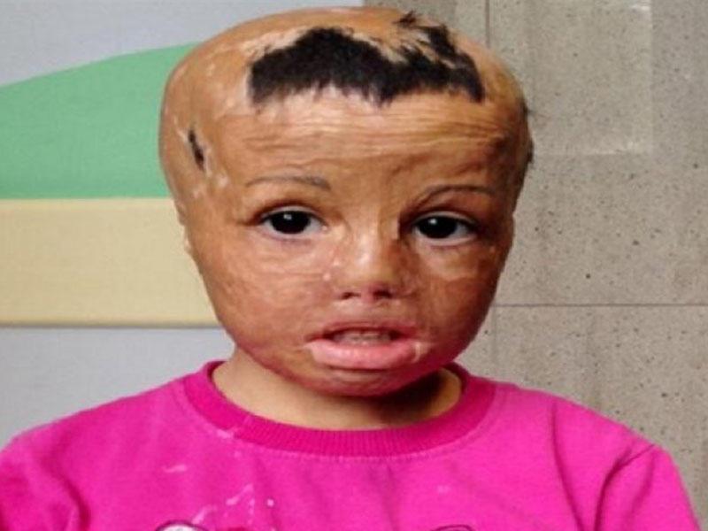 Üzü yanan qıza öz toxumasından yeni üz köçürələcək - FOTO Üzü yanan qıza öz toxumasından yeni üz köçürələcək - FOTO