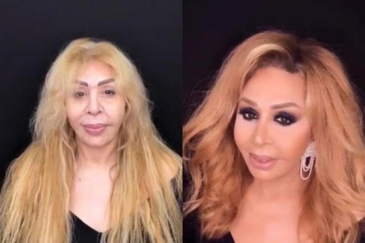 Əməkdar artist estetik əməliyyatın qurbanı oldu: \"Çox peşmanam...\" Əməkdar artist estetik əməliyyatın qurbanı oldu: \"Çox peşmanam...\"