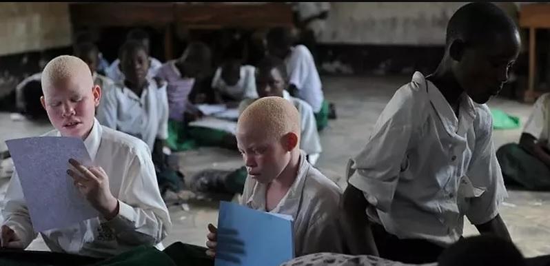 Cadu üçün bəzən albinos insanların cəsədlərini oğurlayırlar