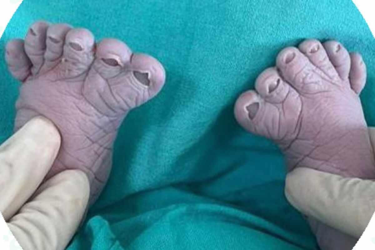 Rusiyalı qadın 12 barmağı olan üçüncü uşağını dünyaya gətirdi