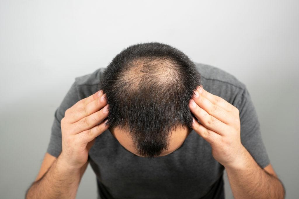 Bu halda saçınızın tökülməsi normal sayılmır - Ekspertdən keçəlliklə bağlı TEST