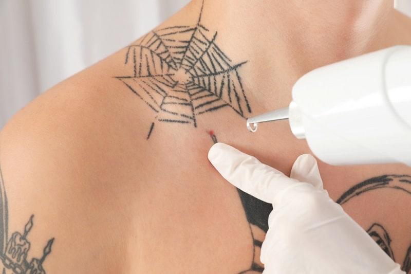 5 ildə 1 milyondan çox tatuaj sildirilib - Səbəb AÇIQLANDI
