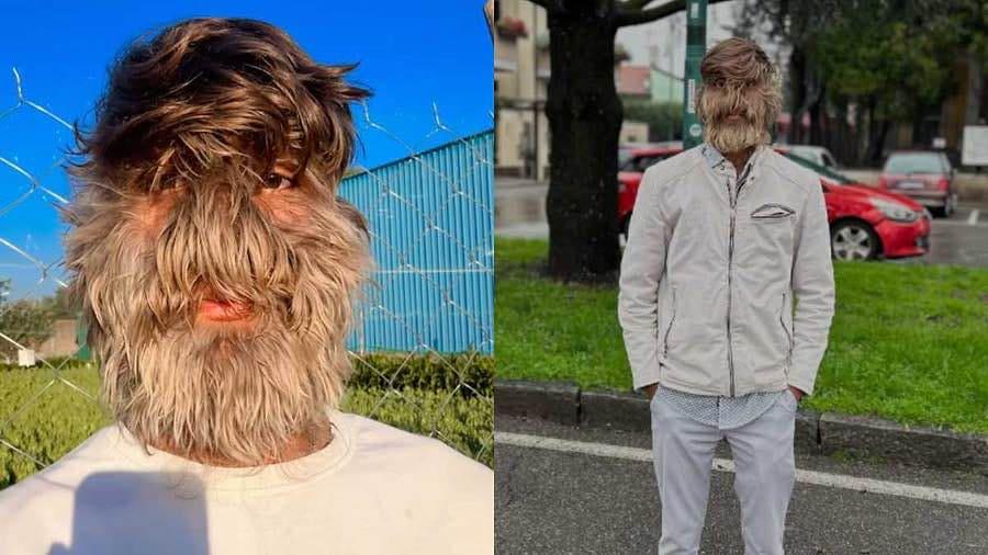 Dünyanın ən tüklü üzünə sahib olmaqla Ginnesin Rekordlar Kitabına düşdü Dünyanın ən tüklü üzünə sahib olmaqla Ginnesin Rekordlar Kitabına düşdü