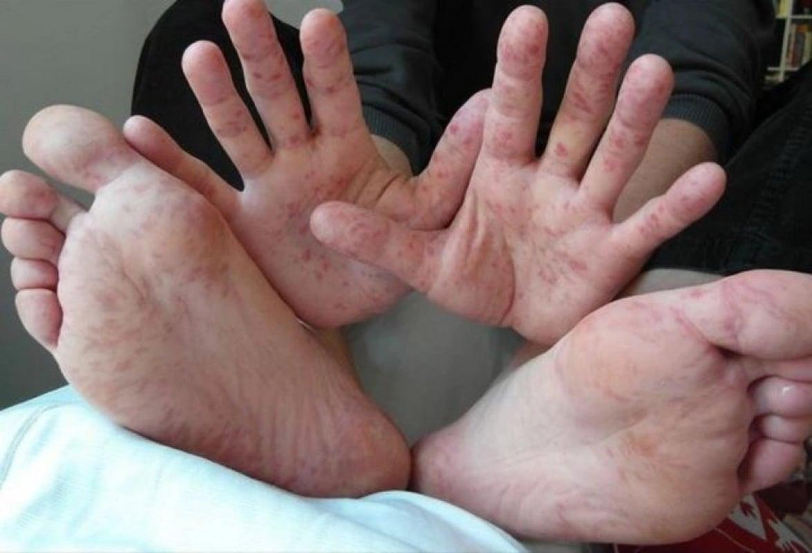 Uşaqlar arasında yeni virus yayılır – Pediatrdan xəbərdarlıq