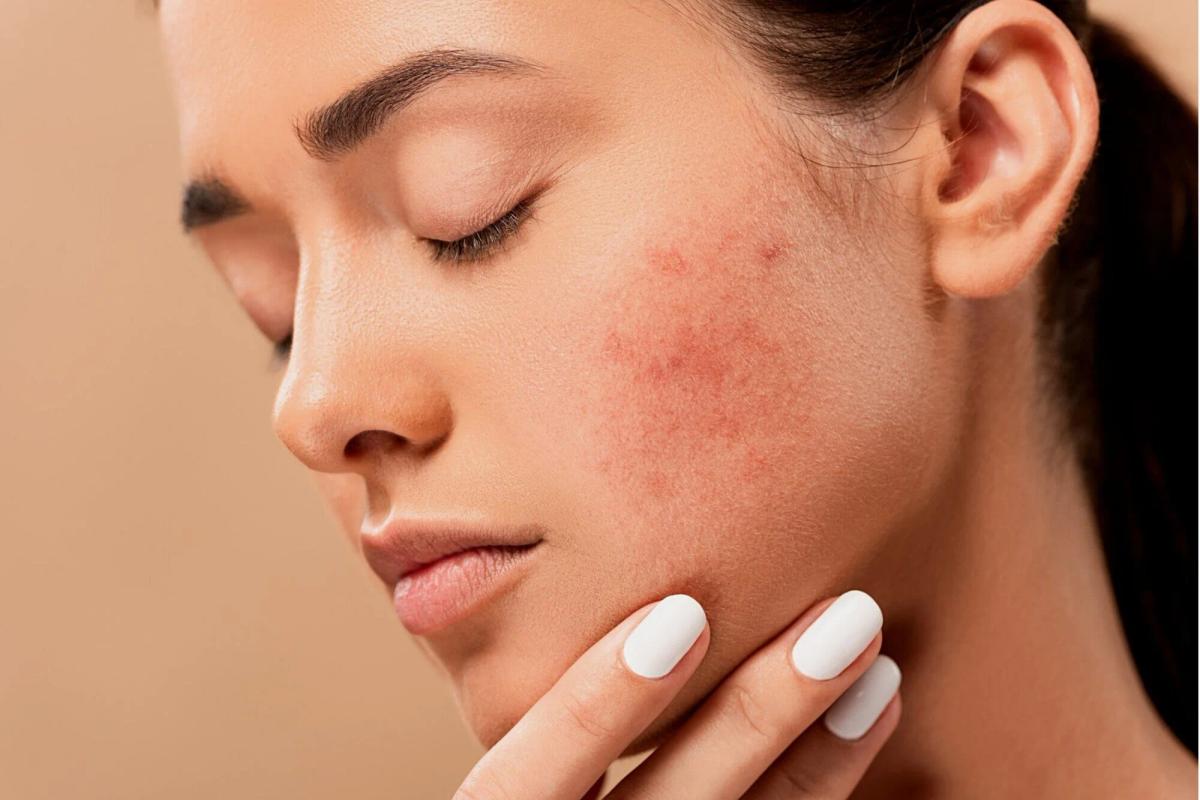 Dermatoloq məşhur mifi dağıtdı: Sızanaqların səbəbi qidalanma deyil Dermatoloq məşhur mifi dağıtdı: Sızanaqların səbəbi qidalanma deyil