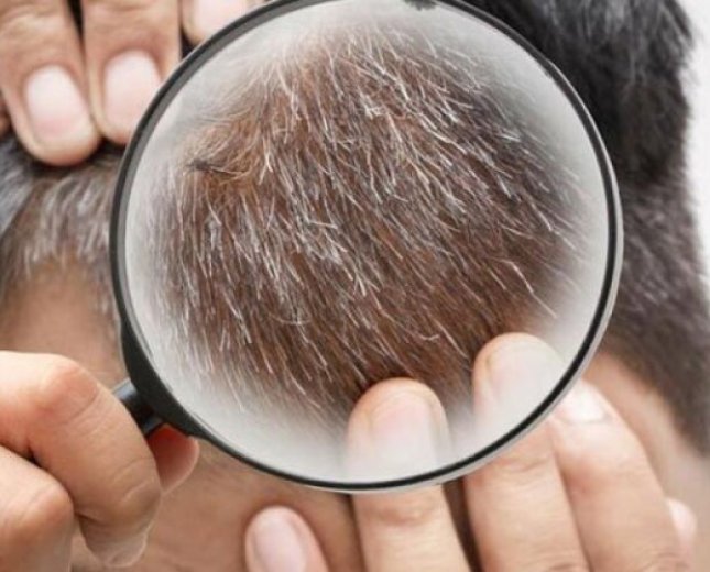 Saçın erkən ağarmasının səbəbi nədir?
