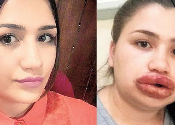 Türk qızın dodaqları Azərbaycanda oxuyan kosmetoloqun qurbanı oldu