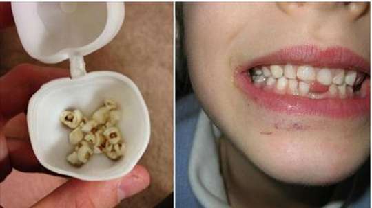 Uşaqlarınızın dişlərini atmayın - Həkimlərdən inanılmaz xəbərdarlıq