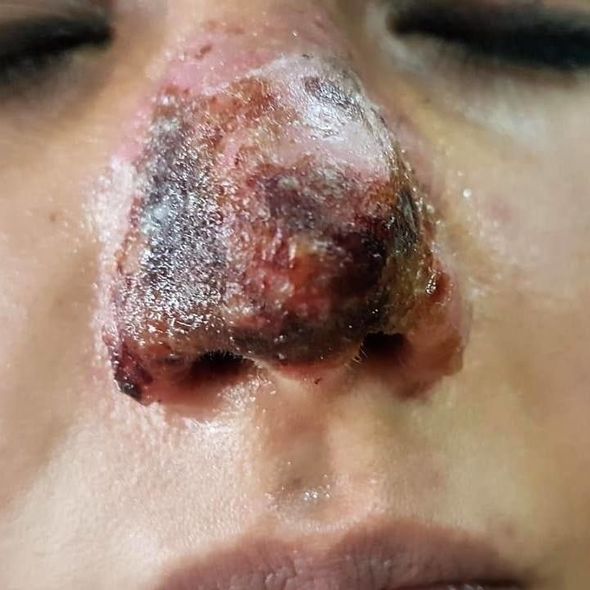 Azərbaycanda dəhşət: Kosmetoloq qızın burnunu inanılmaz hala saldı – Fotolar (18+)