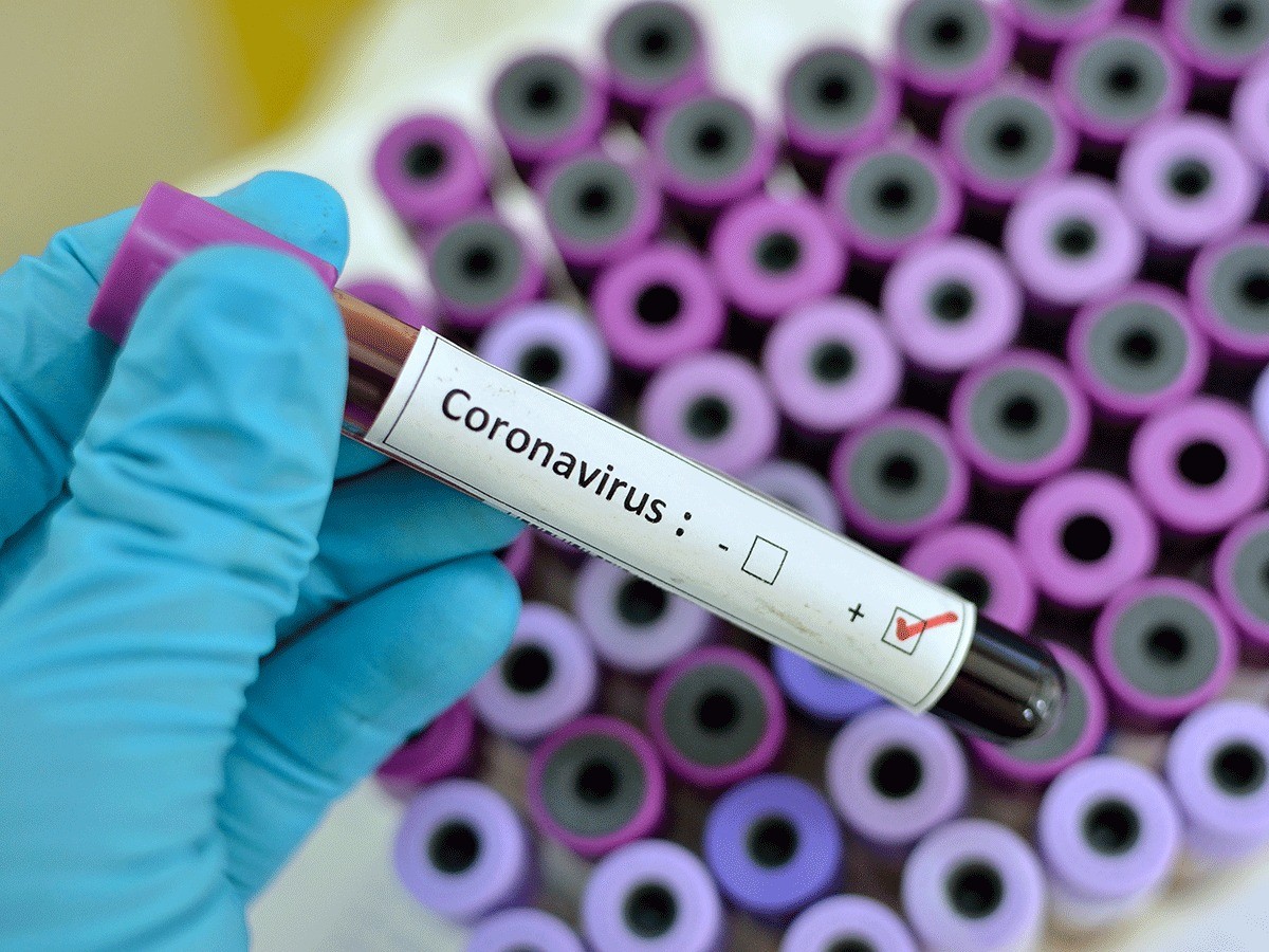 Gürcüstanda koronavirusa yoluxan azərbaycanlının vəziyyəti açıqlandı