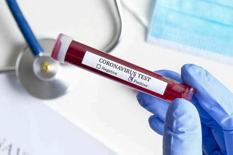 SON DƏQİQƏ: 158 yeni koronavirusa yoluxma qeydə alınıb, 58 nəfər sağalıb
