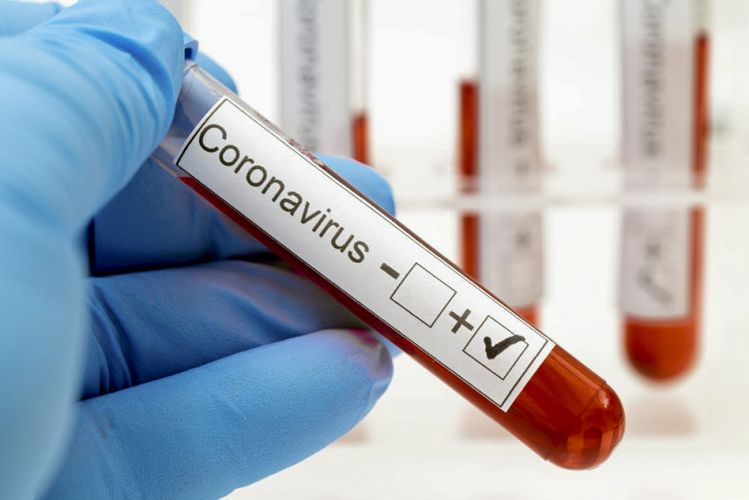 Ermənistanda bir gündə koronavirusdan 20 nəfər öldü