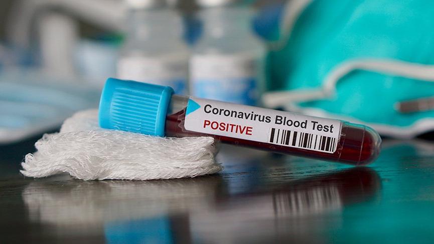 Azərbaycanda daha 39 nəfər koronavirusdan öldü