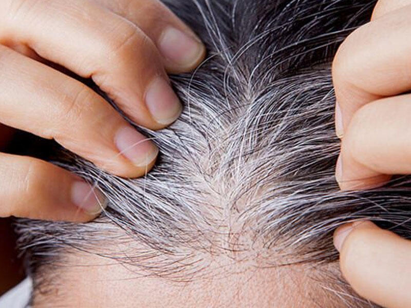 Erkən yaşda saç ağarmasının əsas SƏBƏBLƏRİ - MƏSLƏHƏTLƏR