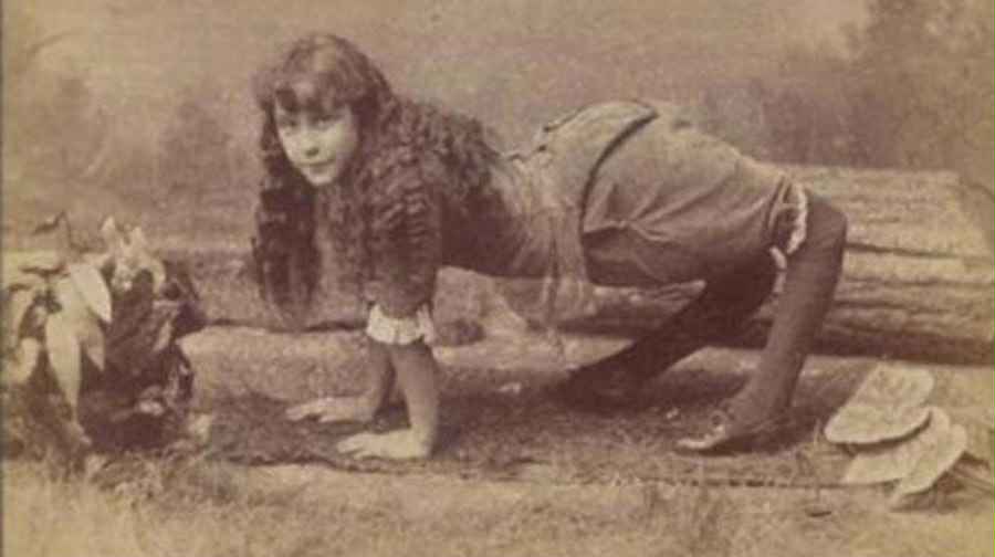 Ayaqları tərsinə olduğu üçün "Dəvə Qız" adlandırıldı - FOTO