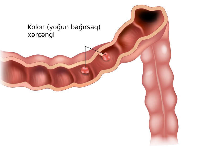 Bu qidalar bağırsaq xərçənginə səbəb olur - ADLAR